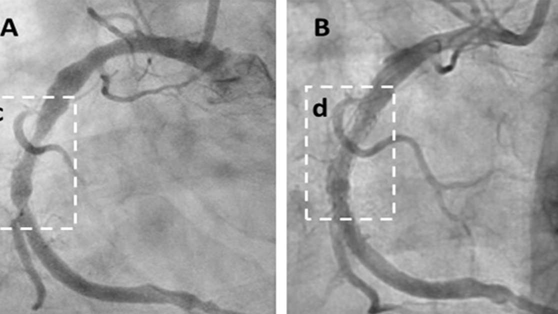 PRESS RELEASE: Australian Company Announces Landmark Paper Showing Cyclodextrin Therapy Reverses Heart Disease, Hailed as “Greatest Development Since Statins”