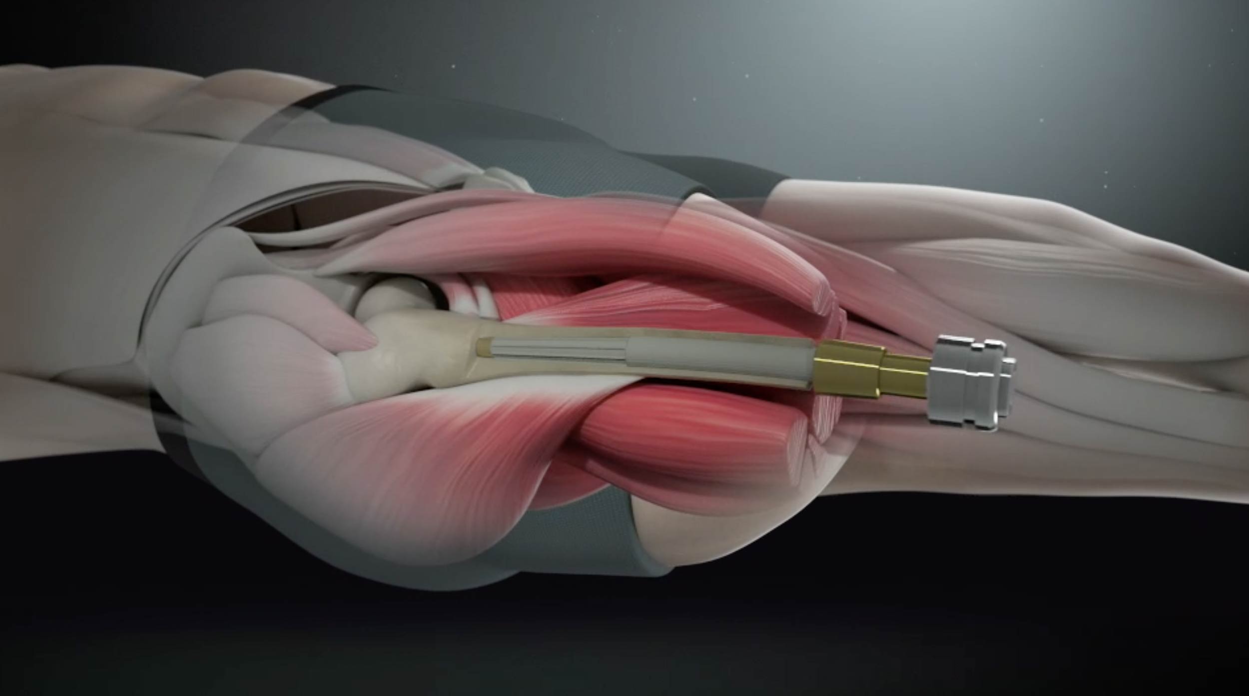 PRESS RELEASE: Systematic Review Shows Professor Munjed Al Muderis’ One-Stage Osseointegration Outperforms Two-Stage Approach