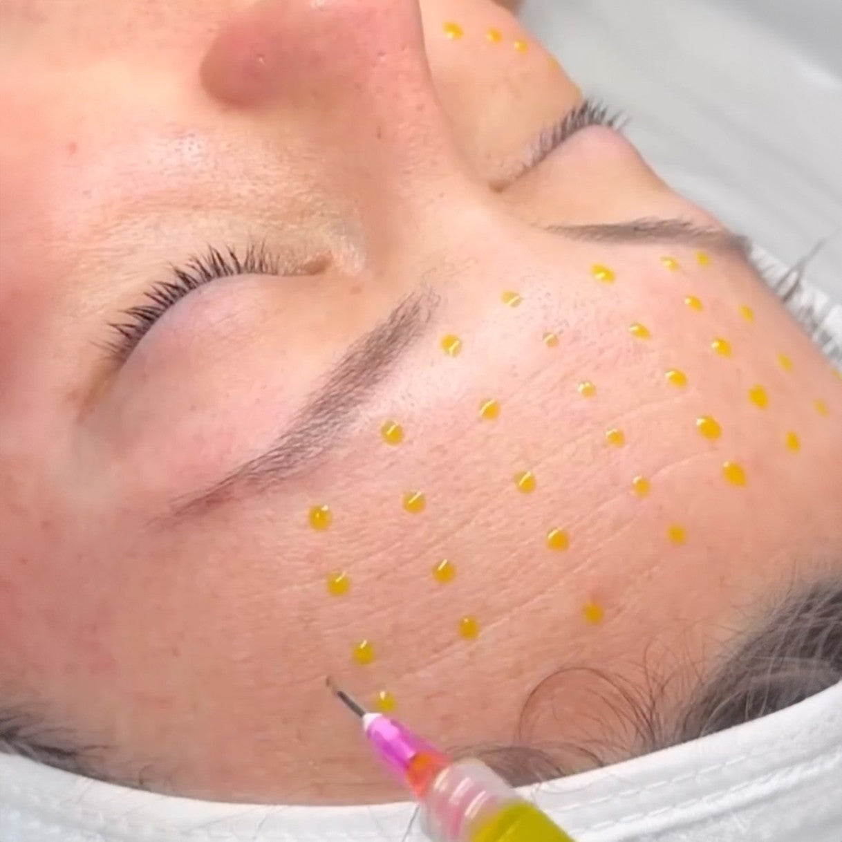 PRESS RELEASE: Revolutionary BioRePeel Treatment Enhances Skin Rejuvenation in Melbourne