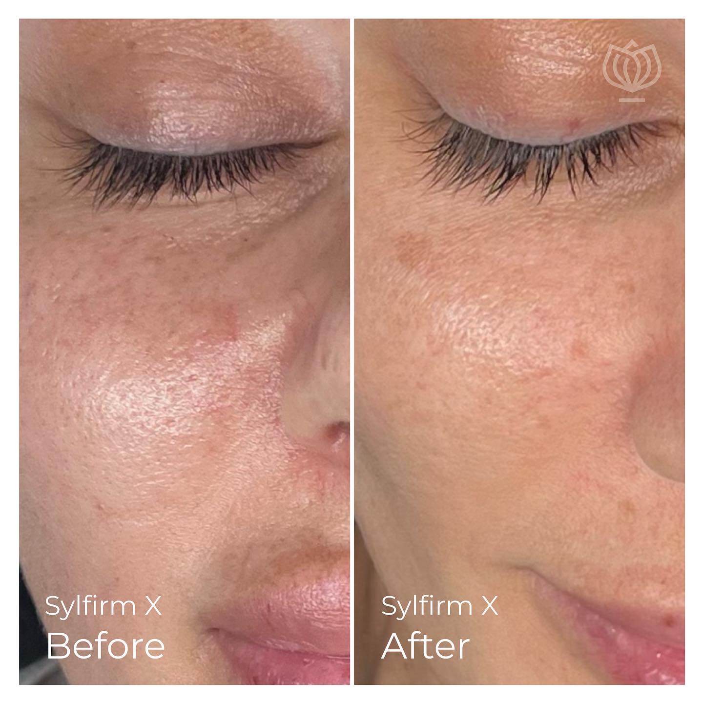 PRESS RELEASE: Sylfirm X Pioneers Non-Invasive Cosmetic Procedures, Revolutionising Skin Rejuvenation in Australia